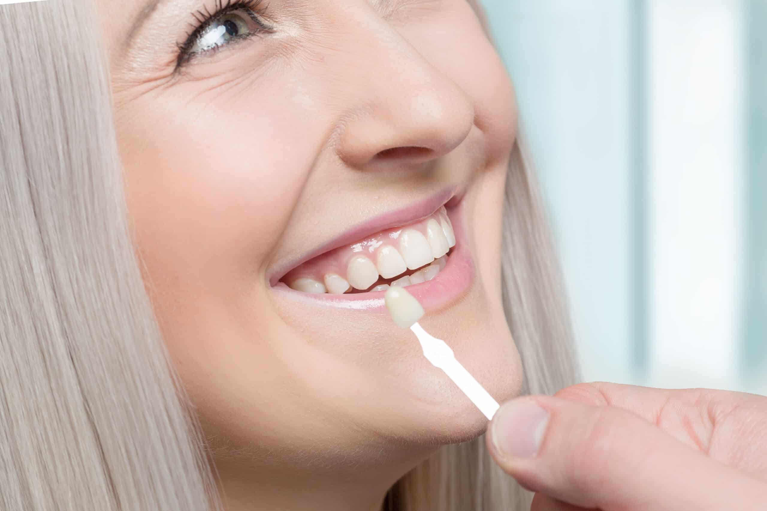 Makellose, strahlend weiße Zähne mit Veneers in Nahaufnahme, leicht geöffnet.